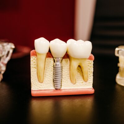 Causes Of Dental Implants