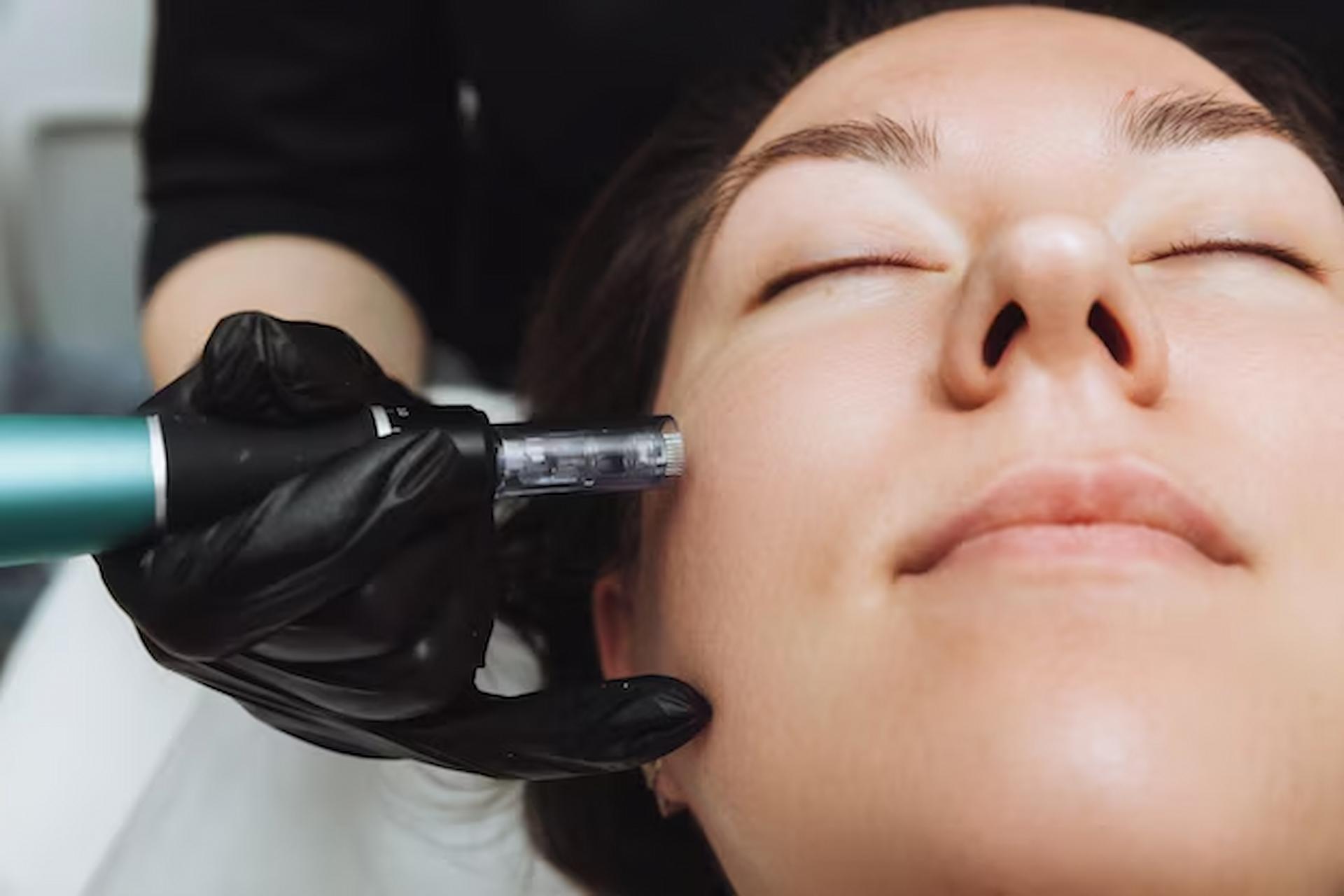 Microneedling Benefits