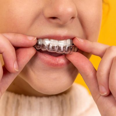 What Are The Prime Advantages Of Wearing Invisalign Braces?